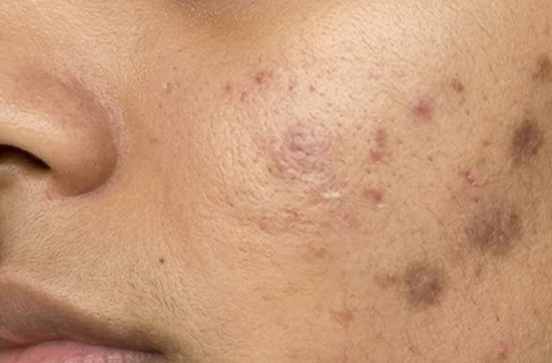 Marcas post-acné