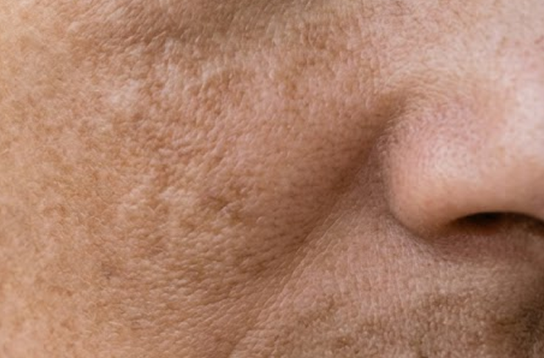 Melasma y manchas hormonales